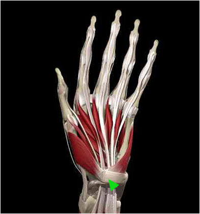 One of the most common hand Tendons In Hand. One of the most common hand